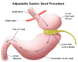 gastric banding problems and side effects