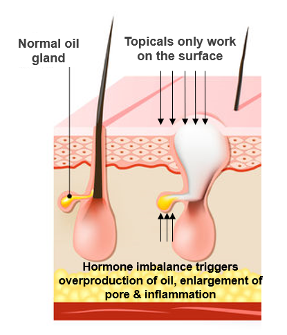 Why Topical Treatments Don't Fix Hormonal Acne | Healthy Remedies