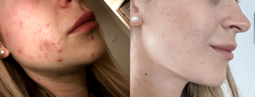 period pimple recovery - before and after
