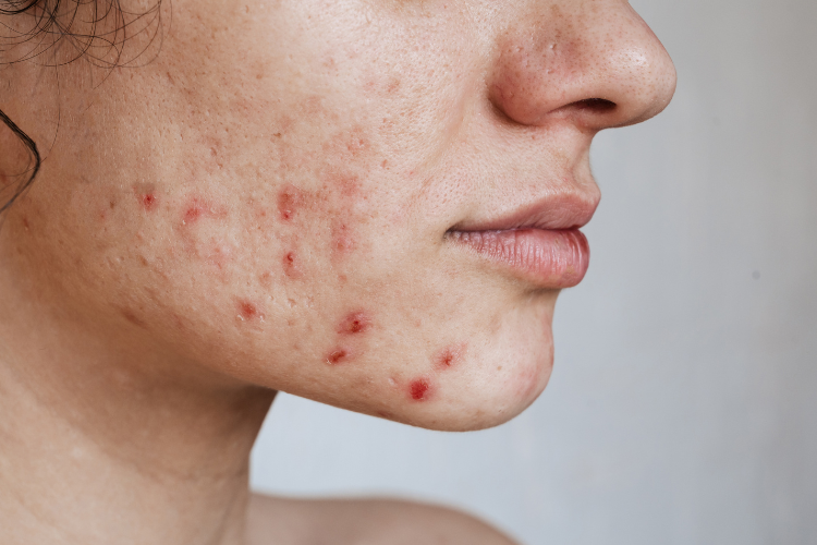 Hormonal acne on chin