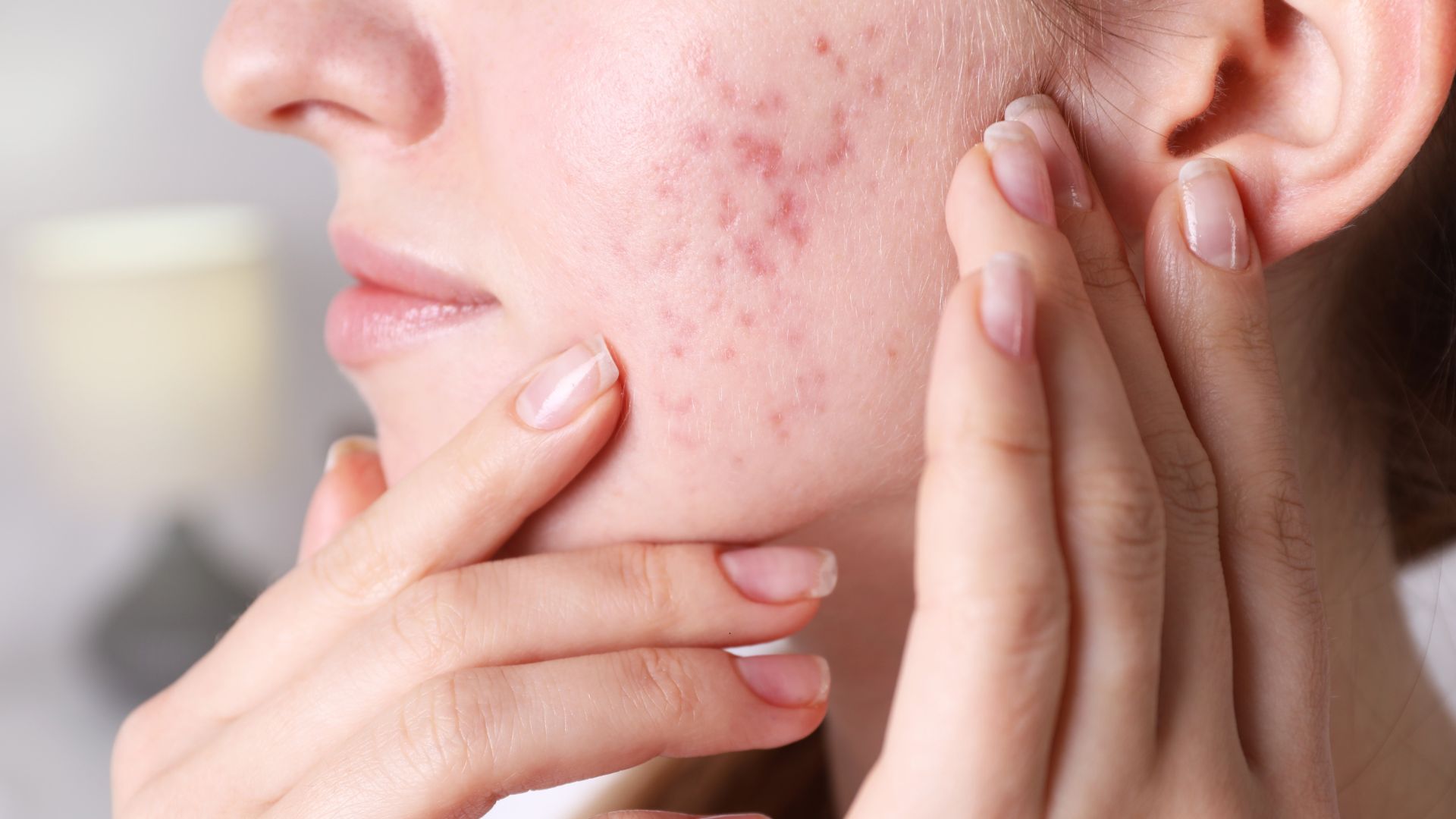 woman with hormonal acne on cheek touching her face