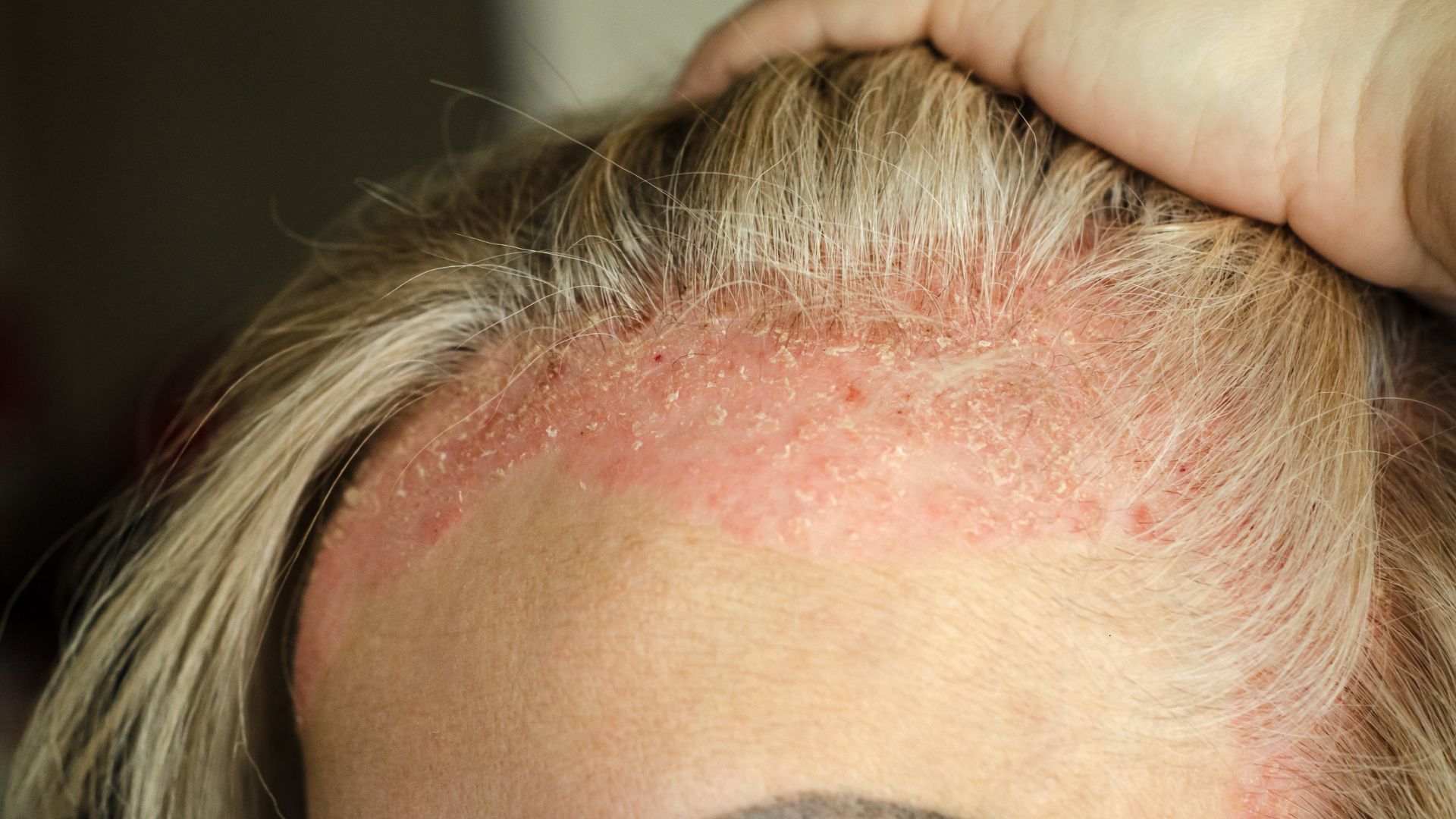 woman with chronic psoriasis