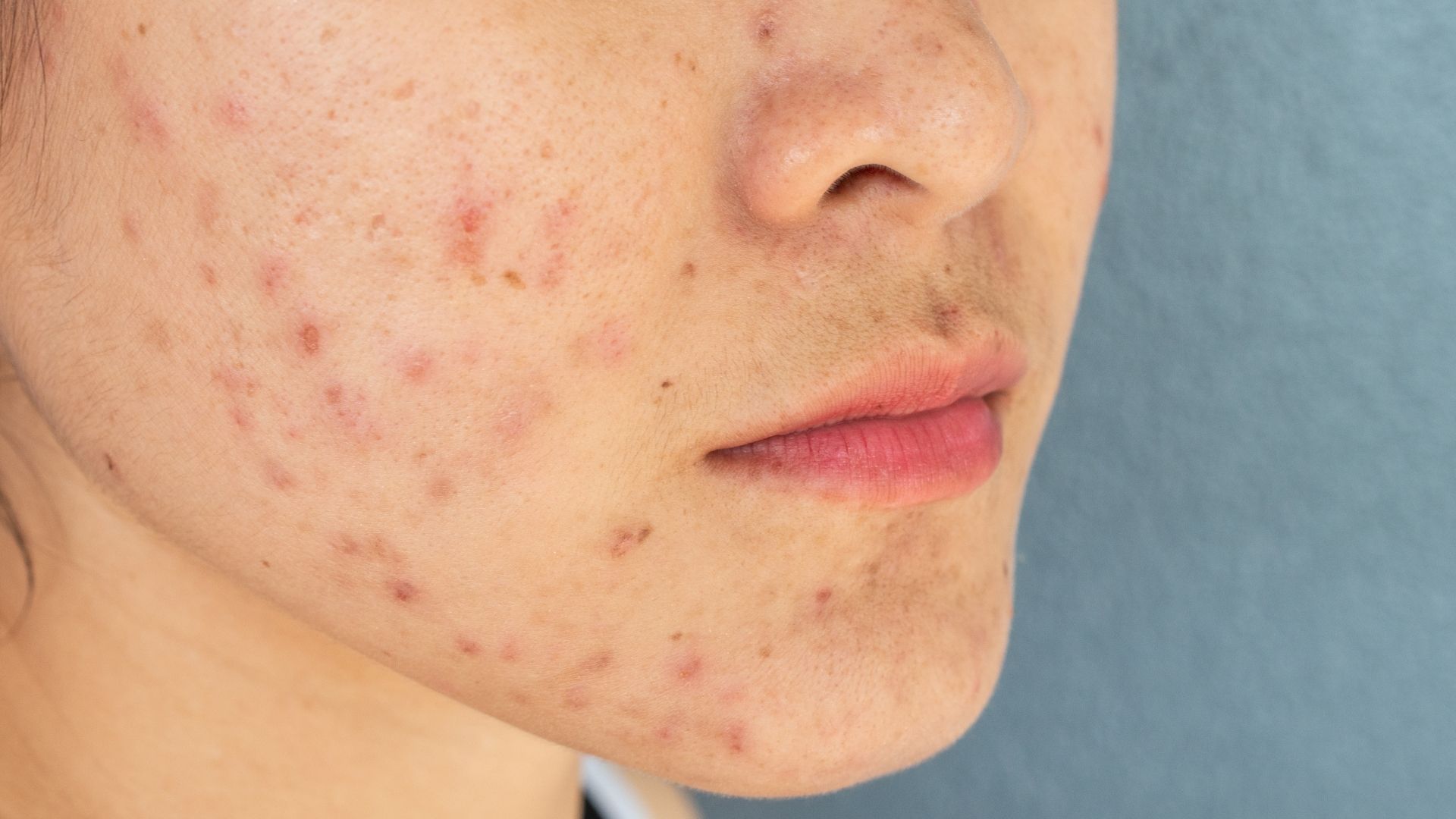 woman with hormonal acne