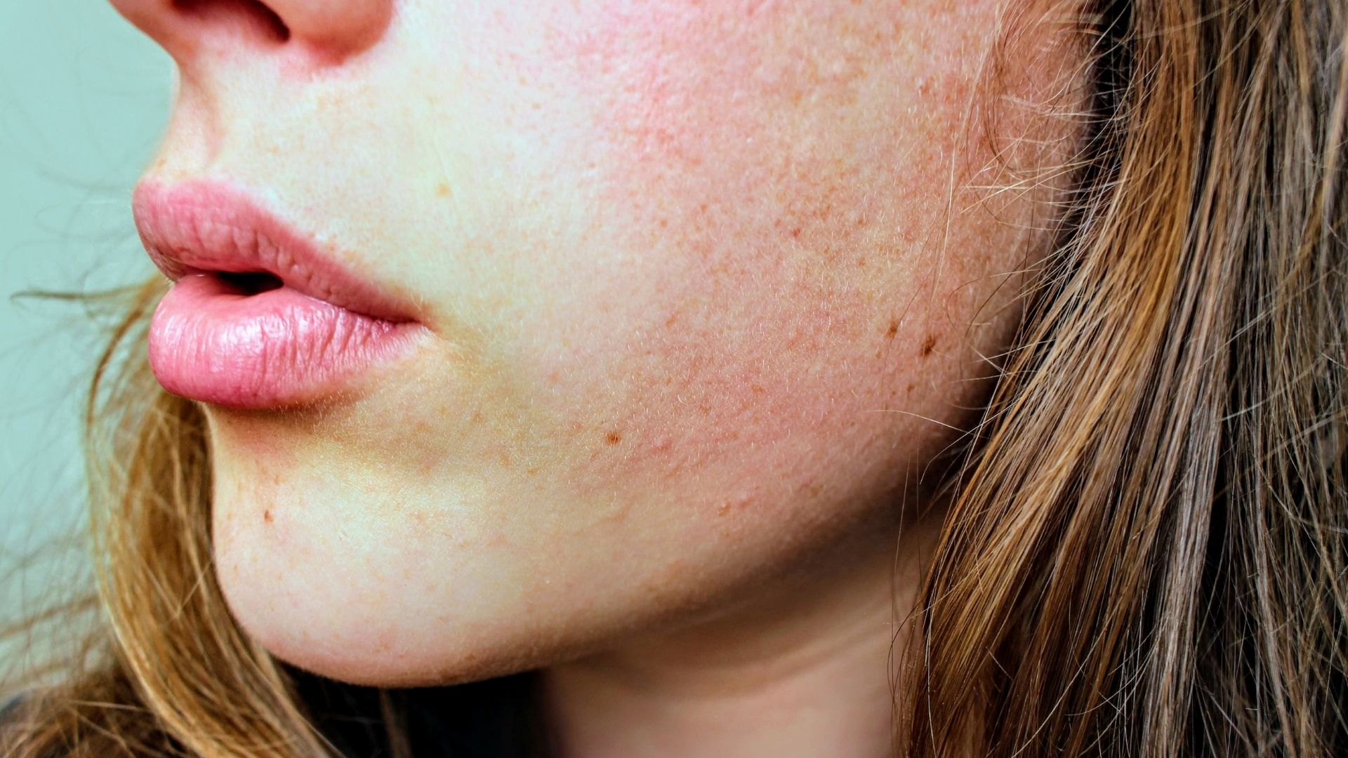 hormonal acne inflammation