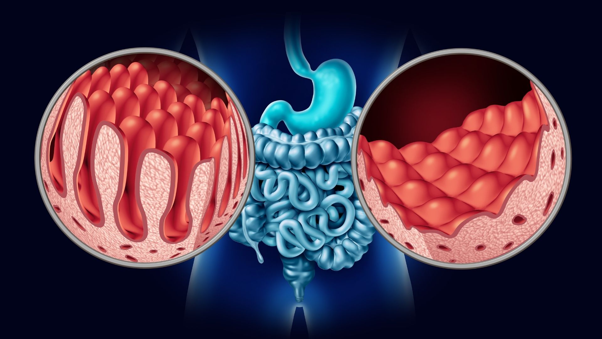 coeliac disease cells